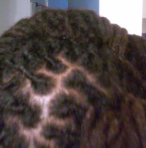 dry itchy scalp with dreads