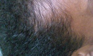 Aloe Vera Gel Applied to Natural Hairline